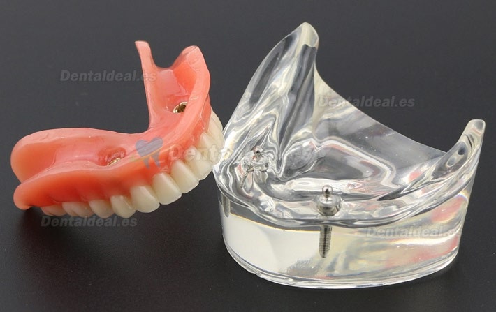 Dental Dientes inferiores Modelo de sobredentadura 2 Implantes Demostración Modelo 6002 01